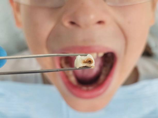 Best Knocked-Out Tooth (Avulsed Tooth) Treatment in Lakehurst, NJ